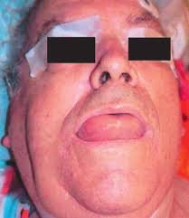 ACE-Hemmer Angioödem