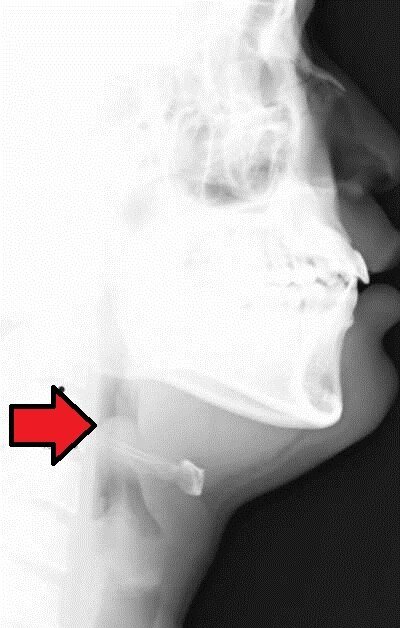 Thumb Sign bei Epiglottitis